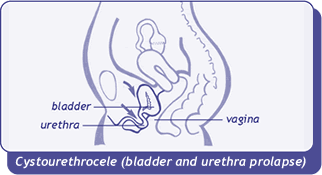 diagram of cystourethrocele