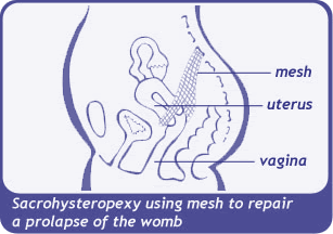 image of Sacrohysteropexy